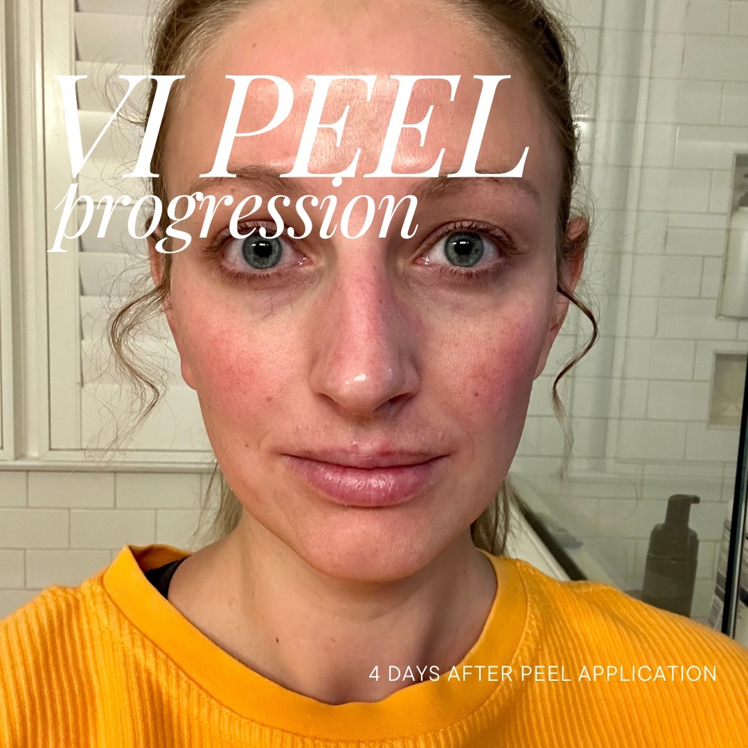themoorecenter- 4 days after chemical peel