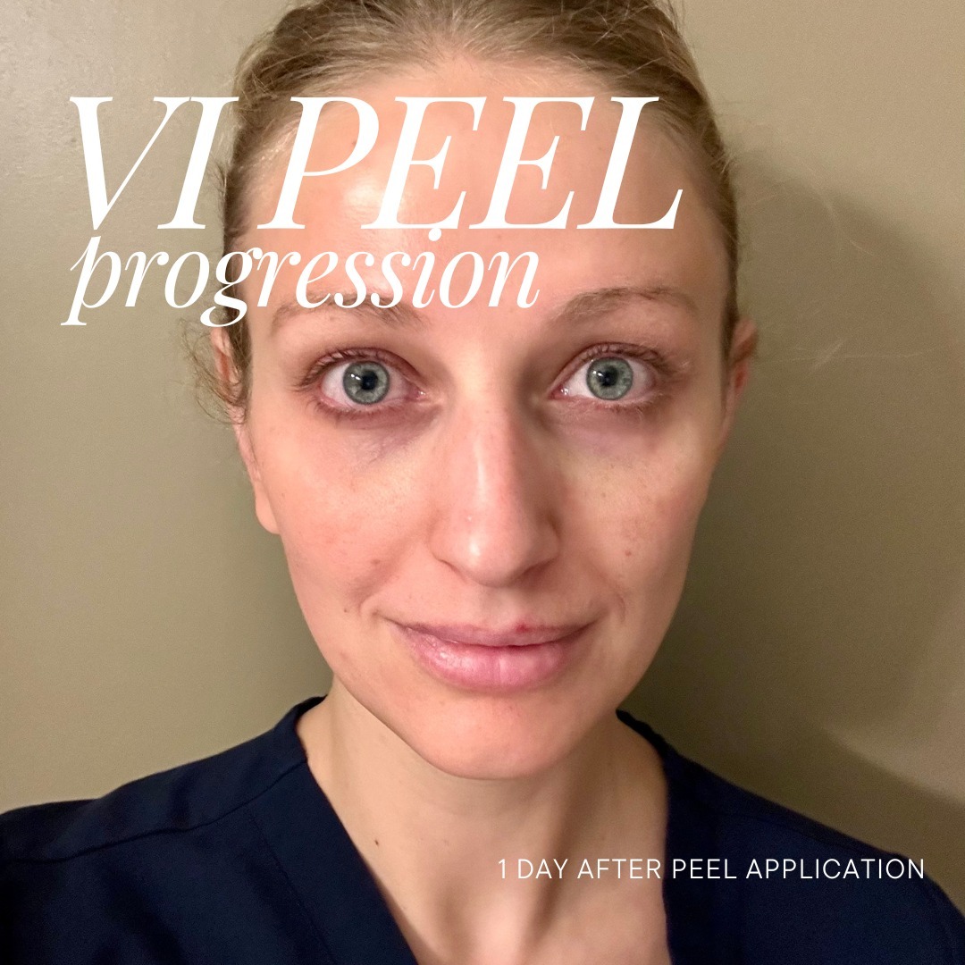 themoorecenter_1 day after chemical peel