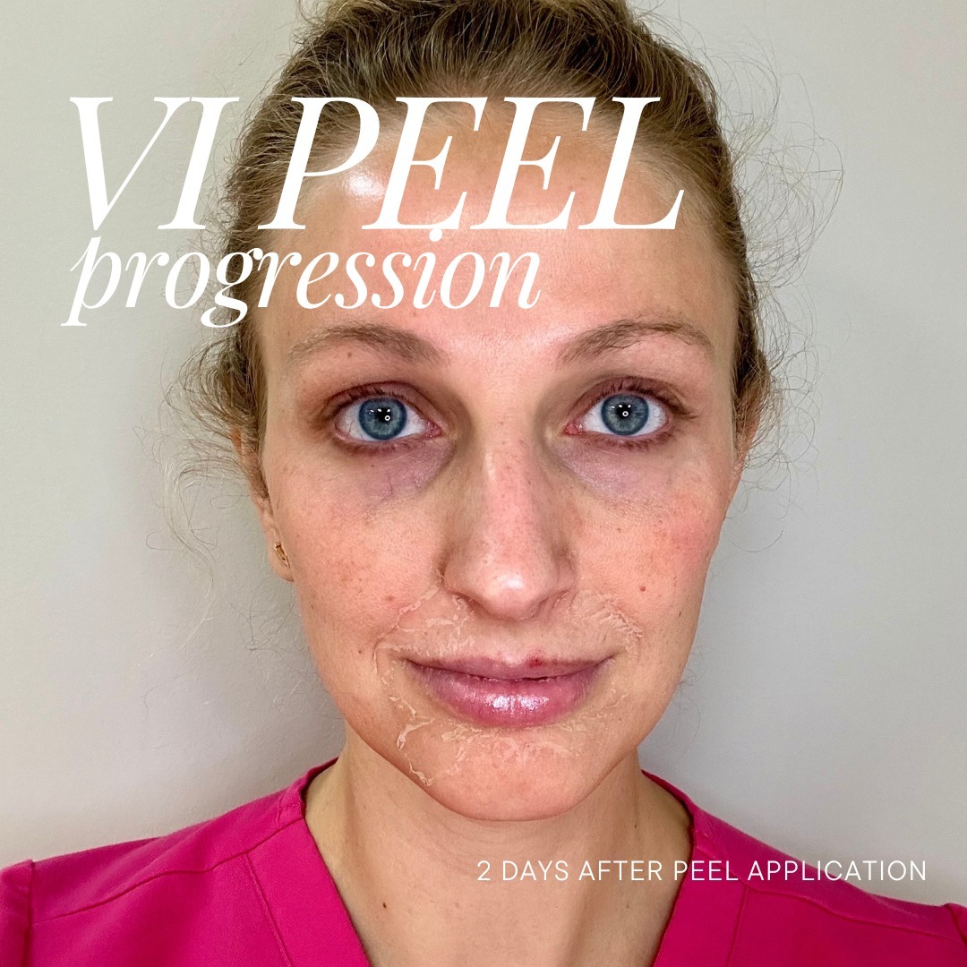 themoorecenter_2 days after chemical peel