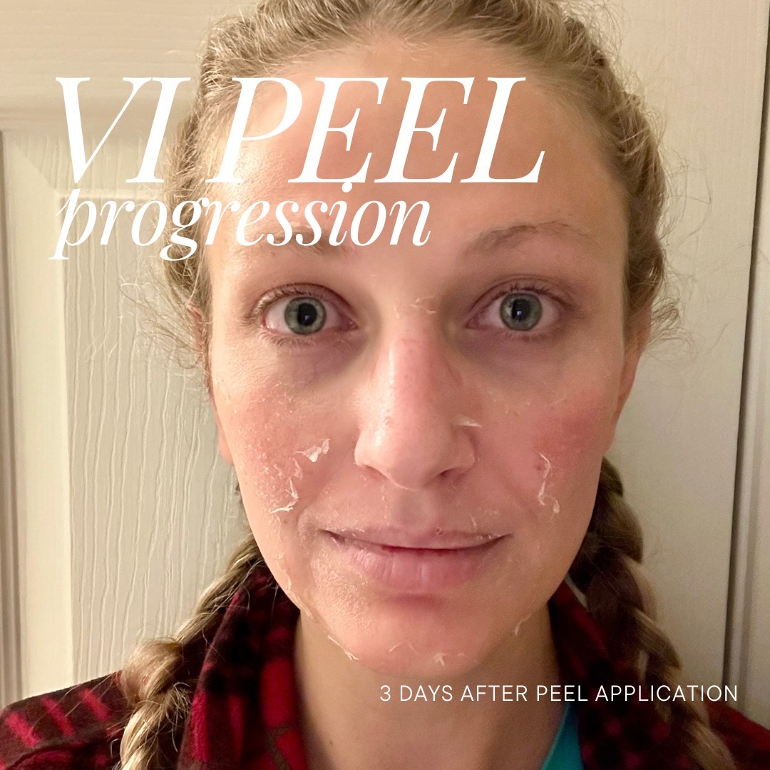 themoorecenter_3 days after chemical peel