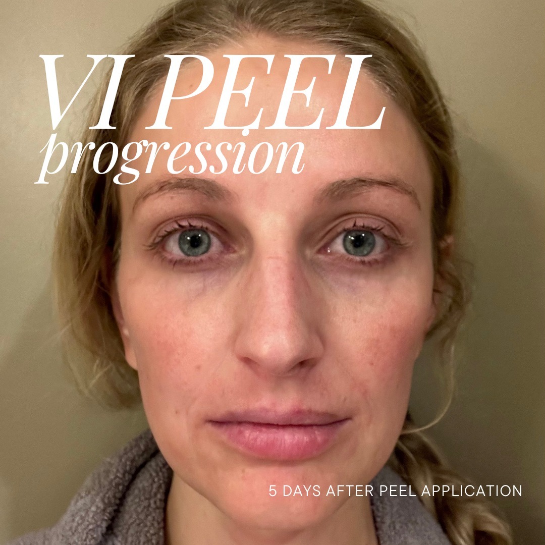 themoorecenter_5 days after chemical peel