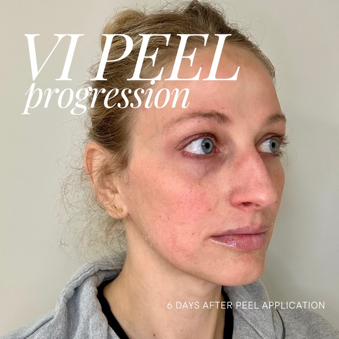 themoorecenter_6 days after chemical peel