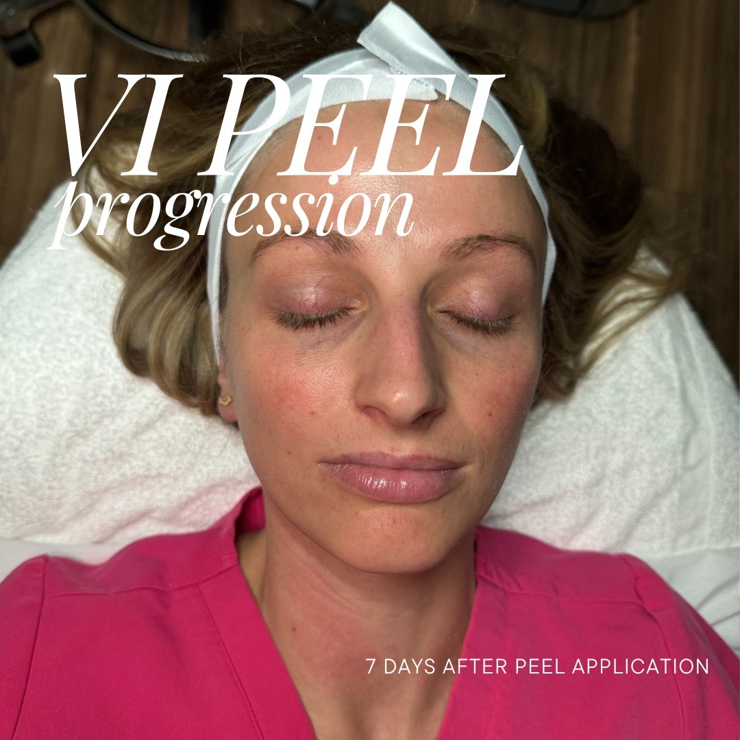 themoorecenter_7 days after chemical peel