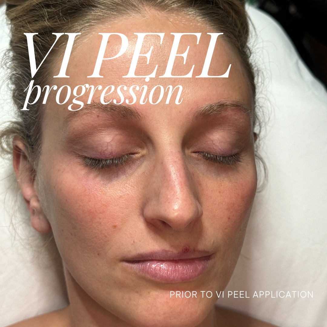 themoorecenter_before chemical peel
