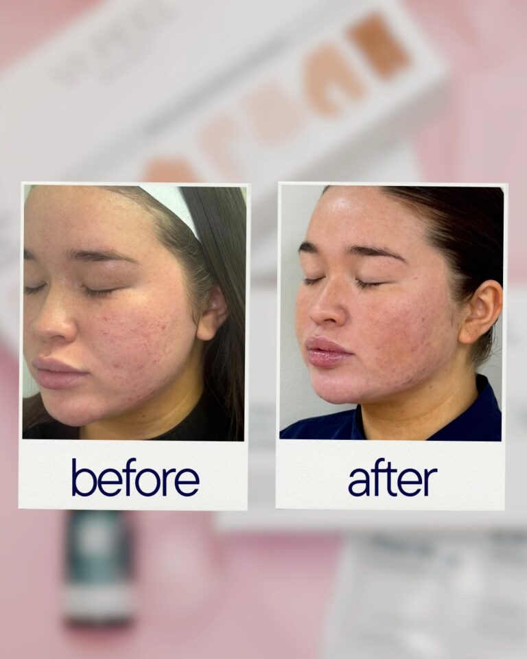 chemical peel before and after