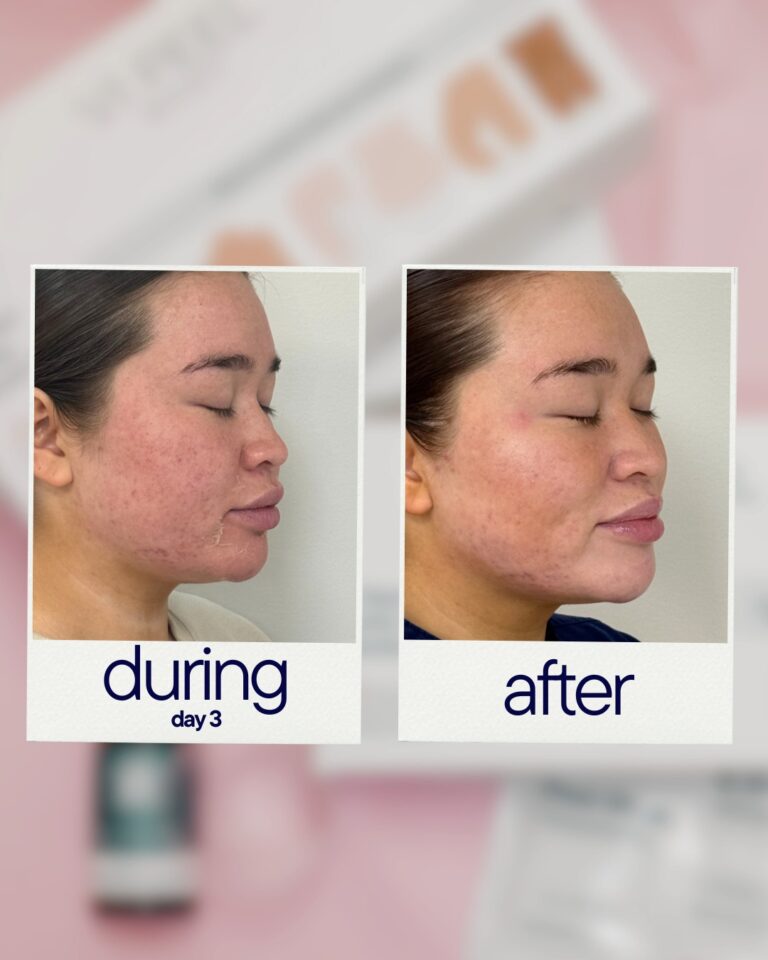 chemical peel results