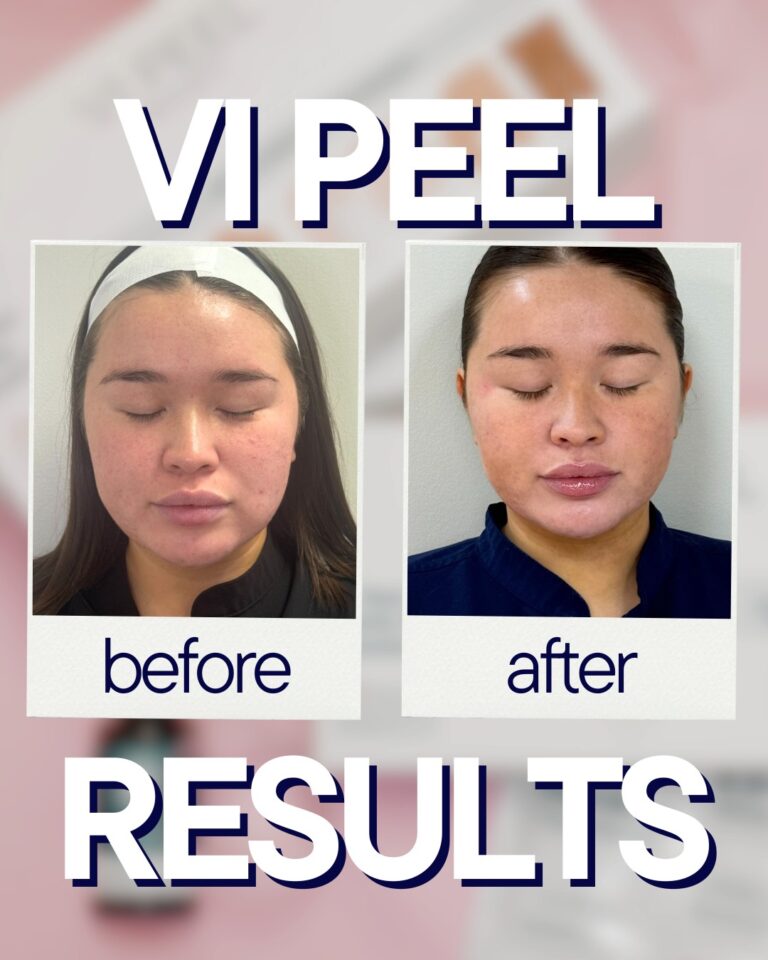 chemical peel in athens ga