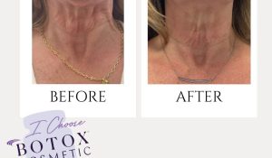 nefertiti lift before and after​