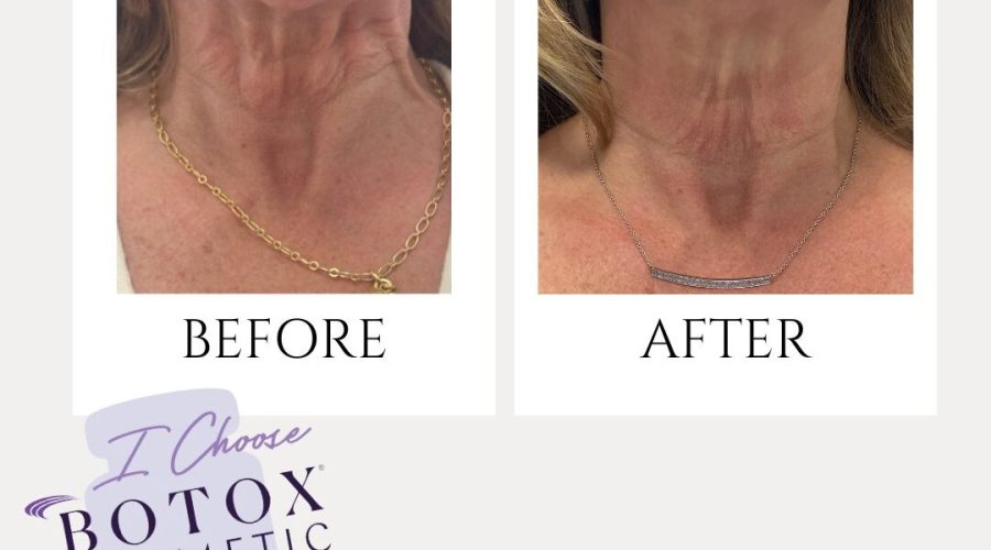 nefertiti lift before and after​